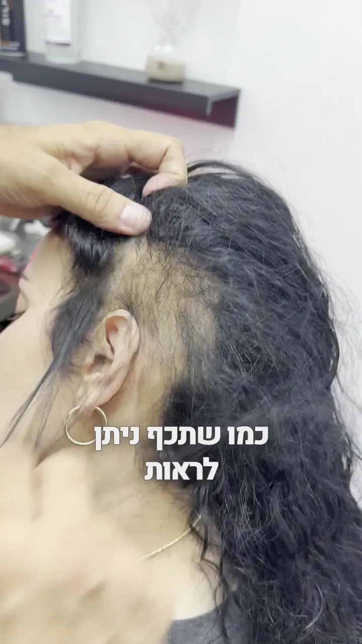 שימור והצמחת שיער